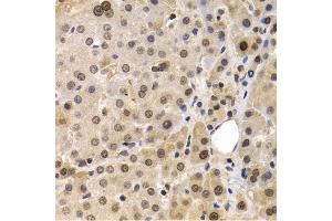 Immunohistochemistry of paraffin-embedded human liver cancer using MAGE-1/MA antibody (ABIN6132325, ABIN6143435, ABIN6143436 and ABIN6221133) at dilution of 1:200 (40x lens). (MAGEA1 抗体  (AA 1-309))