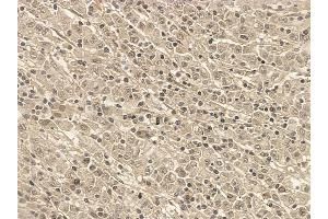 SAP62 Mouse Monoclonal Antibody at 1/100 staining human gastric cancer by IHC-P. (SF3A2 抗体)