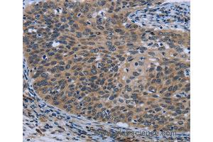 Immunohistochemistry of Human cervical cancer using AVEN Polyclonal Antibody at dilution of 1:30 (AVEN 抗体)
