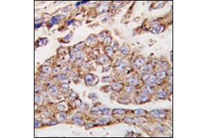 Formalin-fixed and paraffin-embedded human lung carcinoma tissue reacted with CD107a / LAMP1 Antibody (N-term) followed which was peroxidase-conjugated to the secondary antibody, followed by DAB staining. (LAMP1 抗体  (N-Term))
