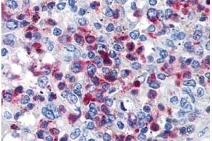 Human Spleen (formalin-fixed, paraffin-embedded) stained with CD63 antibody ABIN239811 at 10 ug/ml followed by biotinylated anti-mouse IgG secondary antibody ABIN481714, alkaline phosphatase-streptavidin and chromogen. (CD63 抗体)