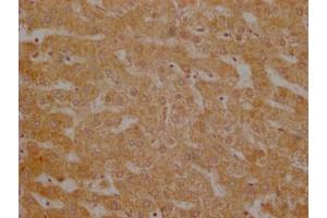 Immunohistochemistry of paraffin-embedded human breast cancer using ABIN7174308 at dilution of 1:100 (USP3 抗体  (C-Term))