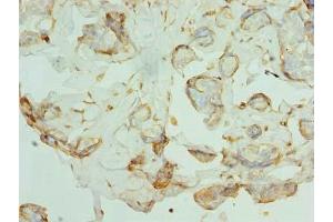 Immunohistochemistry of paraffin-embedded human breast cancer using ABIN7163824 at dilution of 1:100 (PKD1L2 抗体  (AA 1-306))