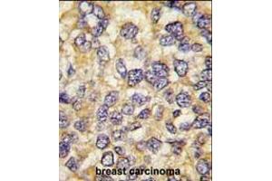 Formalin-fixed and paraffin-embedded human breast carcinoma tissue reacted with UCHL3 antibody (C-term), which was peroxidase-conjugated to the secondary antibody, followed by DAB staining. (UCHL3 抗体  (C-Term))