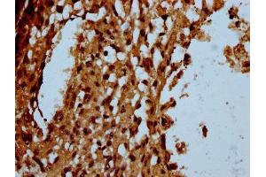 IHC image of ABIN7174180 diluted at 1:100 and staining in paraffin-embedded human melanoma performed on a Leica BondTM system. (C16orf57 抗体  (AA 1-90))
