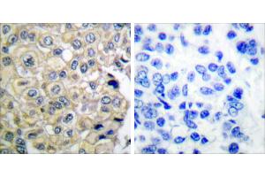 Peptide - +Immunohistochemical analysis of paraffin-embedded human breast carcinoma tissue using FGFR3 antibody. (FGFR3 抗体)