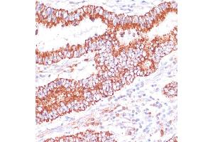 Immunohistochemistry of paraffin-embedded human colon carcinoma using ENTPD6 antibody (ABIN7266897) at dilution of 1:100 (40x lens). (ENTPD6 抗体  (AA 61-300))