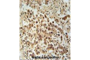 VCX1 Antibody (N-term) immunohistochemistry analysis in formalin fixed and paraffin embedded human testis carcinoma followed by peroxidase conjugation of the secondary antibody and DAB staining. (VCX 抗体  (N-Term))