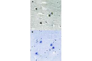 Immunohistochemical staining of human by MERTK/TYRO3 (phospho Y749/681) polyclonal antibody  without blocking peptide (A) or preincubated with blocking peptide (B) under 1:500-1000 dilution. (MERTK 抗体  (pTyr681, pTyr749))