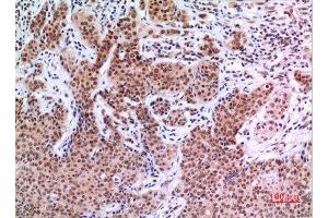 Immunohistochemistry (IHC) analysis of paraffin-embedded Human Mammary Cancer, antibody was diluted at 1:100. (EPAS1 抗体  (Ser343))