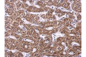 IHC-P Image SDHA antibody detects SDHA protein at cytosol on human hepatoma by immunohistochemical analysis. (SDHA 抗体  (N-Term))