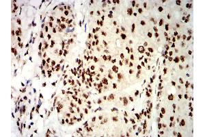 Immunohistochemical analysis of paraffin-embedded bladder cancer tissues using UHRF1 mouse mAb with DAB staining. (UHRF1 抗体  (AA 616-755))