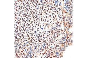 Immunohistochemistry of paraffin-embedded human esophageal cancer using KDM3B Rabbit pAb (ABIN1680577, ABIN3015976, ABIN3015977 and ABIN6219483) at dilution of 1:100 (40x lens). (KDM3B 抗体  (AA 1059-1283))