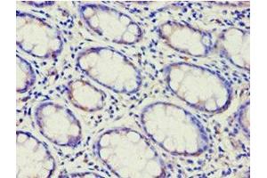 Immunohistochemistry of paraffin-embedded human colon cancer using ABIN7144925 at dilution of 1:100 (ABCF2 抗体  (AA 1-250))