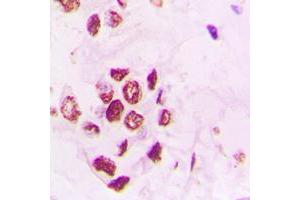 Immunohistochemical analysis of PIAS3 staining in human lung cancer formalin fixed paraffin embedded tissue section. (PIAS3 抗体  (N-Term))