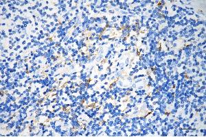 Immunohistochemistry was performed on paraffin-embedded human pancreatic adenocarcinoma using alpha glucosidase antibody (ABIN7797585), 1:200). (Recombinant AGLU 抗体)