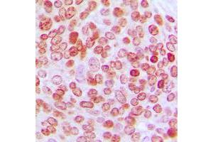 Immunohistochemical analysis of PE2 staining in human ovarian cancer formalin fixed paraffin embedded tissue section. (ERF 抗体  (C-Term))
