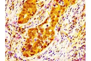 IHC image of ABIN7168283 diluted at 1:300 and staining in paraffin-embedded human pancreatic cancer performed on a Leica BondTM system. (NAT1 抗体  (AA 909-1025))