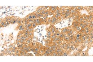 Immunohistochemistry of paraffin-embedded Human breast cancer tissue using TMEFF2 Polyclonal Antibody at dilution 1:35 (TMEFF2 抗体)