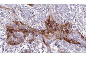 ABIN6274910 at 1/100 staining Human urothelial cancer tissue by IHC-P. (B4GALT1 抗体  (C-Term))