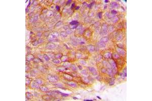 Immunohistochemical analysis of GSK3 alpha (pS21) staining in human breast cancer formalin fixed paraffin embedded tissue section. (GSK3 alpha 抗体  (N-Term, pSer21))