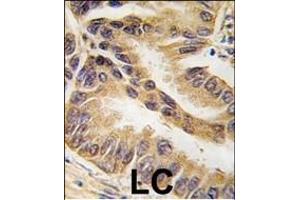 Formalin-fixed and paraffin-embedded human lung carcinoma tissue reacted with RAF1-p, which was peroxidase-conjugated to the secondary antibody, followed by DAB staining. (RAF1 抗体  (AA 599-628))