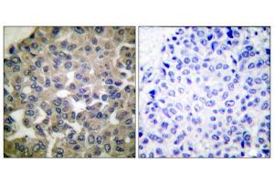 Immunohistochemical analysis of paraffin-embedded human breast carcinoma tissue using PLCG1 (epitope around residue 771) antibody (ABIN5976161). (Phospholipase C gamma 1 抗体  (Tyr771))