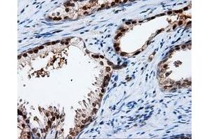 Immunohistochemical staining of paraffin-embedded Adenocarcinoma of ovary tissue using anti-APP mouse monoclonal antibody. (APP 抗体)