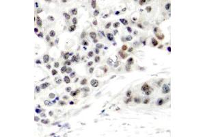 Immunohistochemistry of paraffin-embedded human breast carcinoma using Phospho-ESR1-S106 antibody (ABIN2988004). (Estrogen Receptor alpha 抗体  (pSer106))