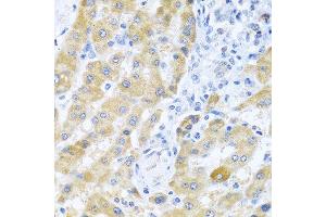 Immunohistochemistry of paraffin-embedded human liver cancer using Gm13125 antibody. (Pramel15 抗体  (AA 67-274))
