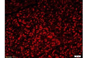 Formalin-fixed and paraffin embedded human gastric carcinoma with Anti-Fascin1 Polyclonal Antibody, Unconjugated  at 1:300, followed by conjugation to the secondary antibody Goat Anti-Rabbit IgG, PE conjugated -PE)used at 1:200 dilution for 40 minutes at 37°C. (Fascin 抗体  (AA 11-110))