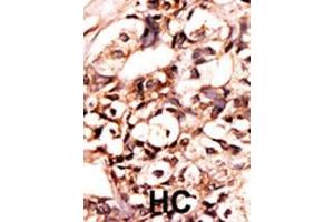 Formalin-fixed and paraffin-embedded human cancer tissue reacted with the primary antibody, which was peroxidase-conjugated to the secondary antibody, followed by AEC staining. (DAXX 抗体  (pSer213))