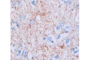 IHC-P analysis of Human Tissue, with DAB staining. (ROR1 抗体  (AA 540-795))