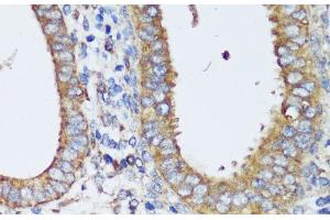 Immunohistochemistry of paraffin-embedded Human uterine cancer using ERK1 / ERK2 Polyclonal Antibody at dilution of 1:200 (40x lens). (ERK1/2 抗体)