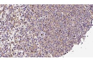 ABIN6273217 at 1/100 staining Human lymph cancer tissue by IHC-P. (CRLS1 抗体  (Internal Region))