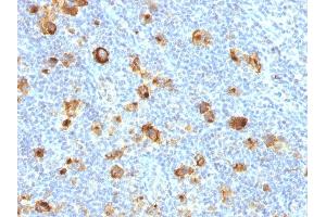 Formalin-fixed, paraffin-embedded human Hodgkin's Lymphoma stained with CD15 Rabbit Recombinant Monoclonal Antibody (FUT4/1478R). (Recombinant CD15 抗体)