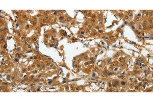 Immunohistochemistry of paraffin-embedded Human lung cancer tissue using AKAP12 Polyclonal Antibody at dilution 1:40 (AKAP12 抗体)