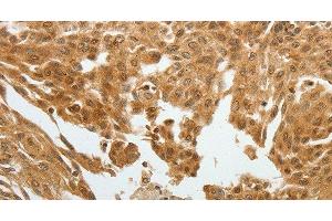Immunohistochemistry of paraffin-embedded Human cervical cancer tissue using RETNLB Polyclonal Antibody at dilution 1:40 (RETNLB 抗体)