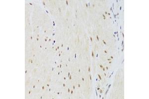 Immunohistochemistry of paraffin-embedded human gastric cancer using CSRP3 Antibody (ABIN2562048) at dilution of 1:100 (40x lens). (CSRP3 抗体)