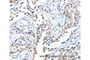 Immunohistochemistry of Human esophagus cancer using AOX1 Polyclonal Antibody at dilution of 1:65
