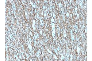 Formalin-fixed, paraffin-embedded human Brain stained with Neurofilament Mouse Recombinant Monoclonal Antibody (rNF421). (Recombinant NEFH 抗体)