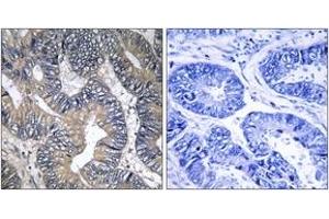 Immunohistochemistry analysis of paraffin-embedded human colon carcinoma tissue, using GTPBP2 Antibody. (GTPBP2 抗体  (AA 31-80))
