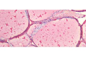 Detection of TG in Human Thyroid Tissue using Polyclonal Antibody to Thyroglobulin (TG) (Thyroglobulin 抗体  (AA 2083-2333))