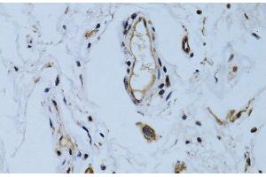Immunohistochemistry of paraffin-embedded Human colon carcinoma using MCAM Polyclonal Antibody at dilution of 1:100 (40x lens). (MCAM 抗体)