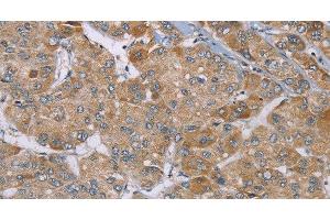 Immunohistochemistry of paraffin-embedded Human liver cancer using ACTN2 Polyclonal Antibody at dilution of 1:30 (ACTN2 抗体)