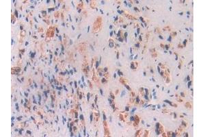 Detection of BCHE in Human Prostate cancer Tissue using Polyclonal Antibody to Butyrylcholinesterase (BCHE) (Butyrylcholinesterase 抗体  (AA 29-150))