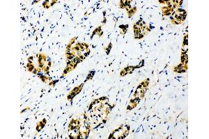 Anti-splicing factor 1 antibody, IHC(P) IHC(P): Human Lung Cancer Tissue (Splicing Factor 1 抗体  (N-Term))