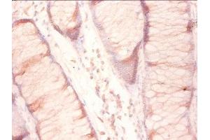 Immunohistochemistry of paraffin-embedded human colon cancer using ABIN7142788 at diluton of 1:50 (RPL27 抗体  (AA 2-136))