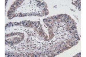 Detection of VEGF121 in Human Liver Cancer Tissue using Monoclonal Antibody to Vascular Endothelial Growth Factor 121 (VEGF121) (VEGF121 抗体  (AA 28-147))