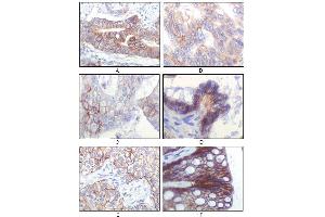 Immunohistochemical analysis of paraffin-embedded human gastric adenocarcinoma(A), colon adenocarcinoma(B), endometrial carcinoma(uterus)(C), ovary adenocarcinoma(D), lung squamous cell carcinoma(E), stomach epithelium mucosae(F), showing membrane localization using IGF1R antibody with DAB staining. (IGF1R 抗体)